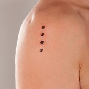 Kambo burns - dots on man's shoulder. Traditional amazon frog medicine.